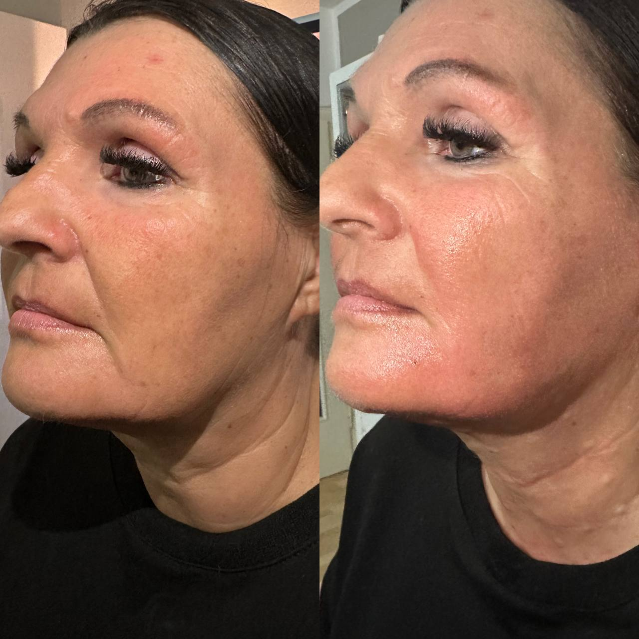 Предоставленный коллаж до и после Endolift